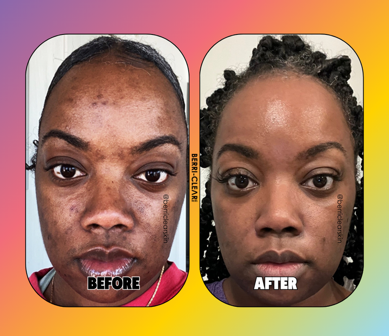 BERRI-CLEAR+ 5 BERRY SUPERFRUIT SERUM