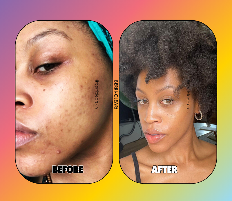 BERRI-CLEAR+ 5 BERRY SUPERFRUIT SERUM