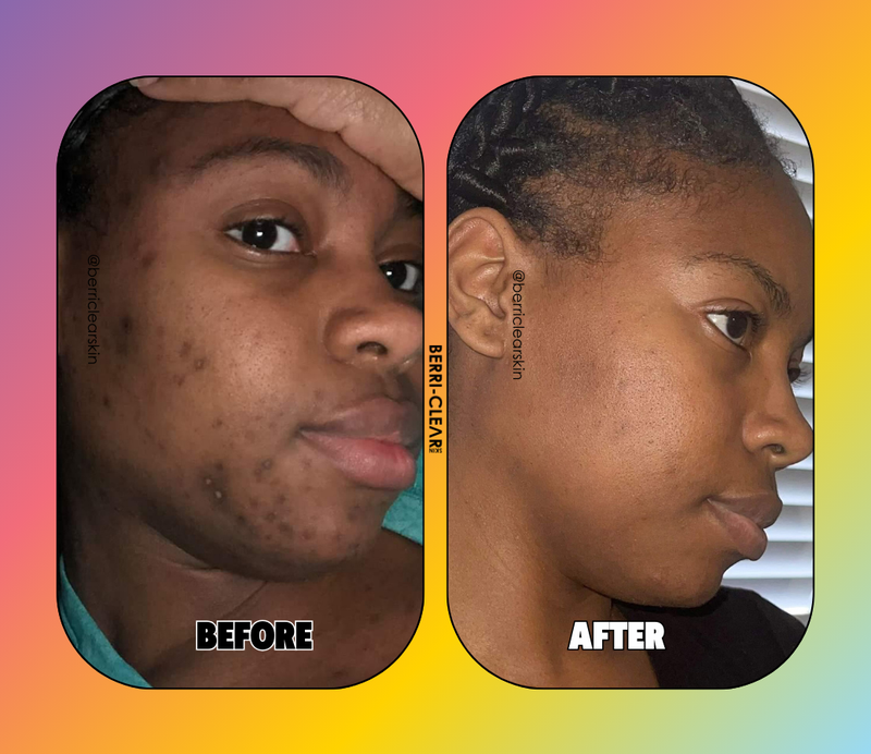 BERRI-CLEAR+ 5 BERRY SUPERFRUIT SERUM