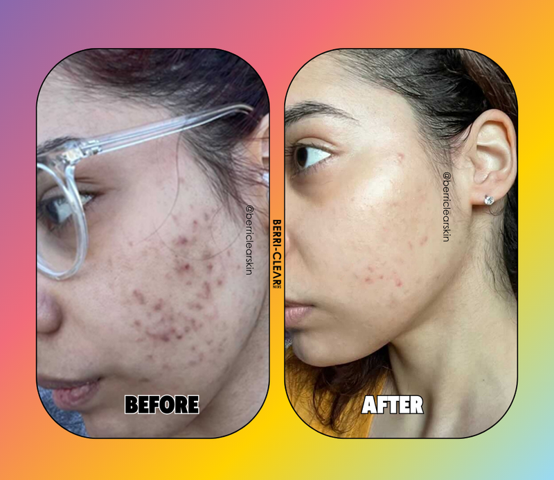 BERRI-CLEAR+ 5 BERRY SUPERFRUIT SERUM